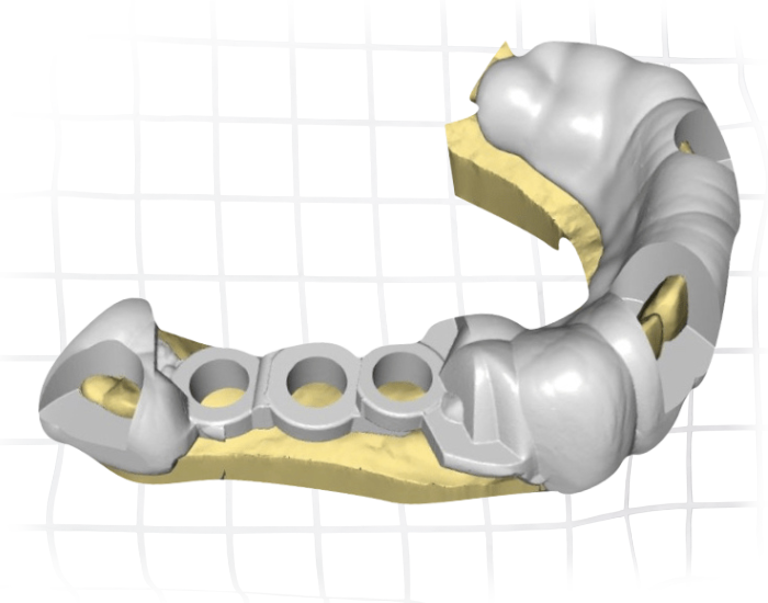 Aligner Image 3