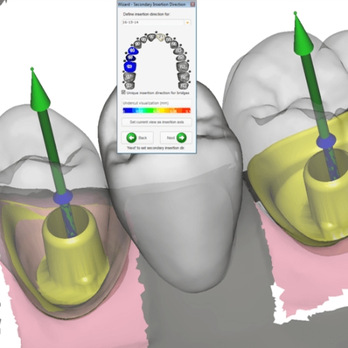 couronne sur implant