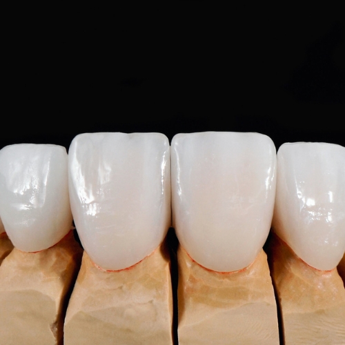 ZIRCONE  stratifié ( 3p )