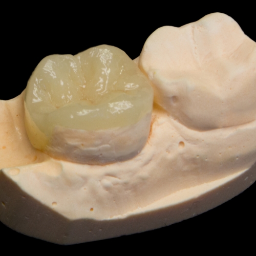 ONLAY- INLAY  ( zircon )